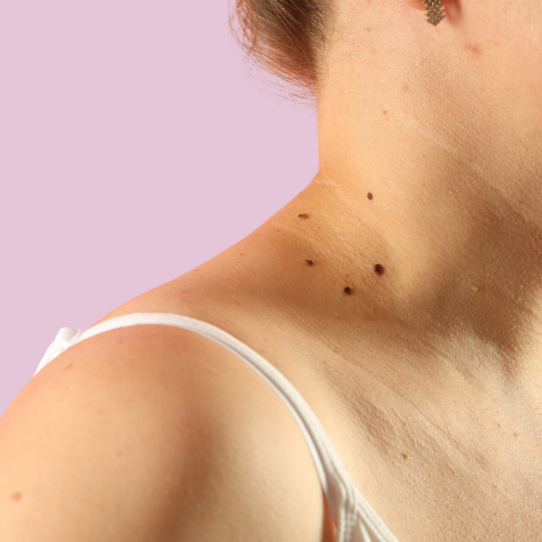 A close-up image of a woman's neck and shoulders where moles are visible.